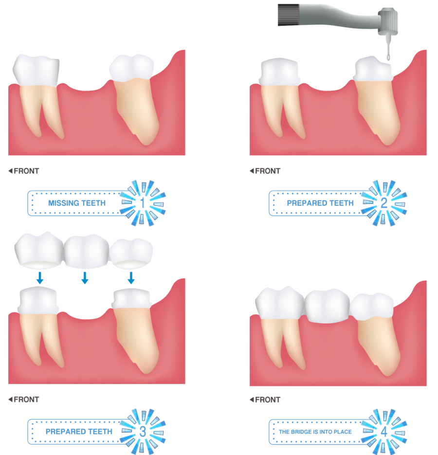 bridge-e1488404256526 Crowns & Bridges at Lawton Dental Care – General & Cosmetic Dentist Alsager