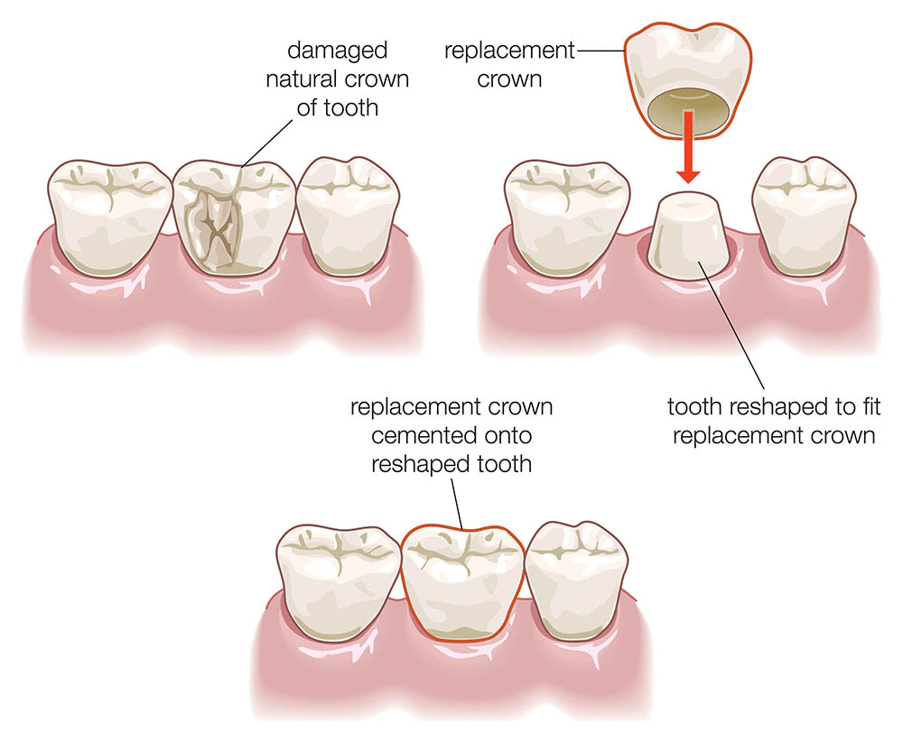 dental-crown-procedure-illustration Crowns & Bridges at Lawton Dental Care – General & Cosmetic Dentist Alsager